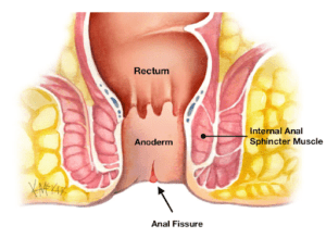 All You Need To Know About Anal Fissure Dr Antonio Privitera