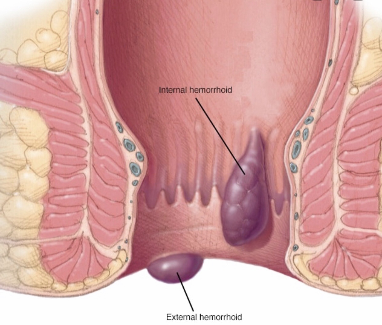 External and internal hemorrhoids