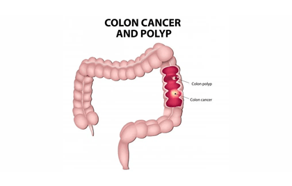 Colon cancer and polyp