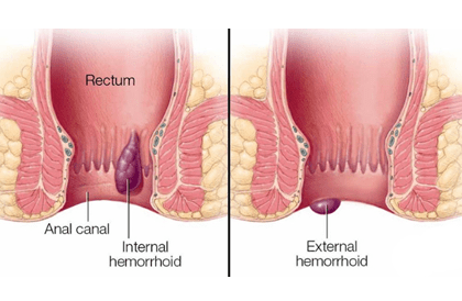 Internal and External hemorrhoids