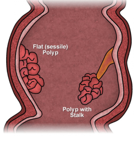 Endocopy Procedure, Polyp