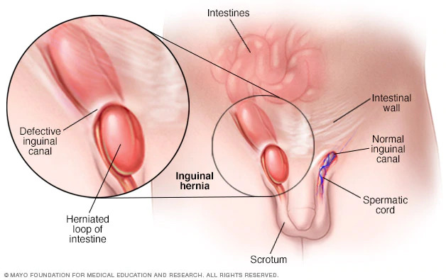 The anatomy of an inguinal hernia