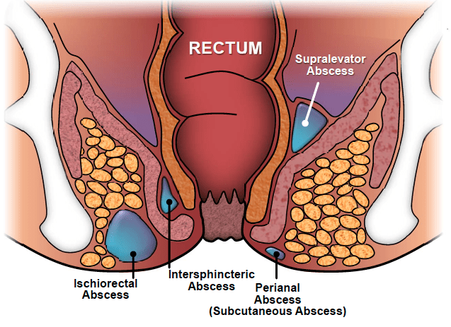 Anal Abscess