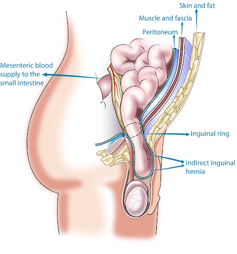 hernia specialist dubai