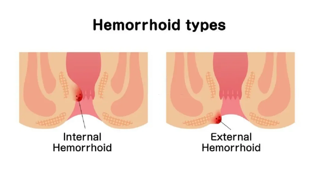 البواسير الداخلية كل شئ تريد أن تعرفه عنها