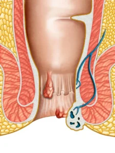 علاج الناسور الشرجي في دبي
