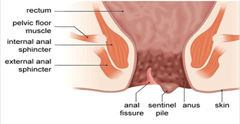 Anal Fissure Symptoms