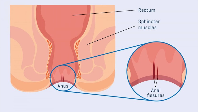 Анальные трещины - причины, симптомы, диагностика, лечение и профилактика