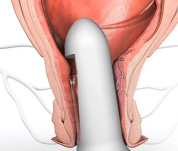 Doppler-Guided Hemorrhoidal Artery Ligation