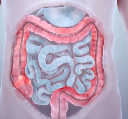 Colorectal Cancer