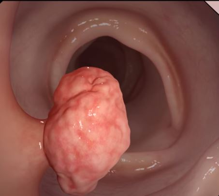 Colorectal Cancer