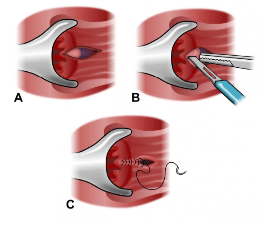 Anal Fissure Treatment