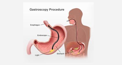 Gastroscopy Procedure