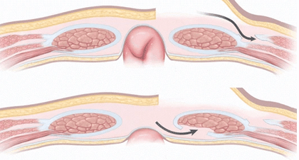 Abdominal Wall Reconstruction & Abdominoplasty