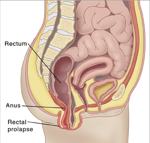 Rectal Prolapse