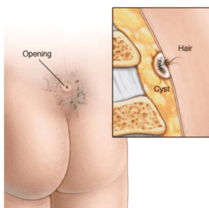 Pilonidal Sinus - Evergreen Surgical Pilonidal Clinic