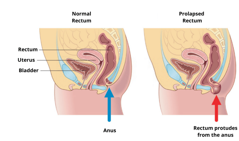 Rectal prolapse