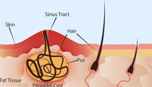 pilonidal cyst