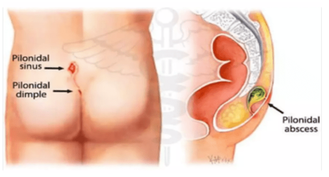 Pilonidal Sinus