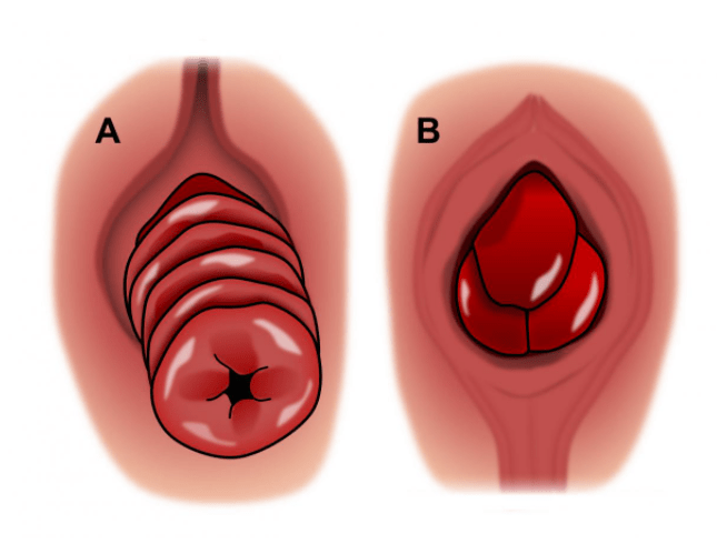 Rectal prolapse sample