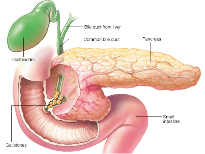 Gallbladder Stones