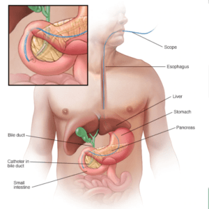 Gallbladder stones diagnoses