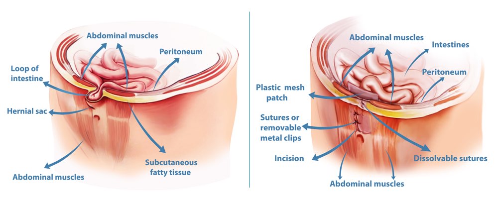 Hernia