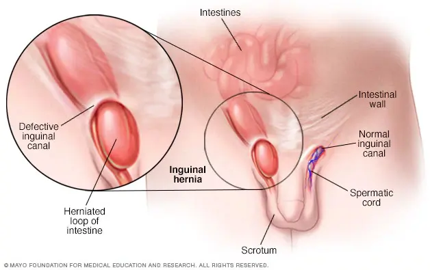 The anatomy of an inguinal hernia