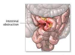 Intestinal Obstruction