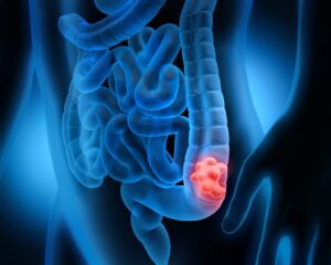 Early symptoms of colon cancer
