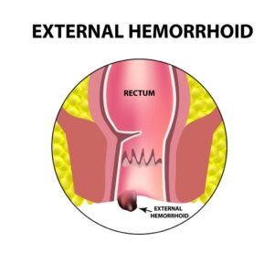 External hemorrhoids