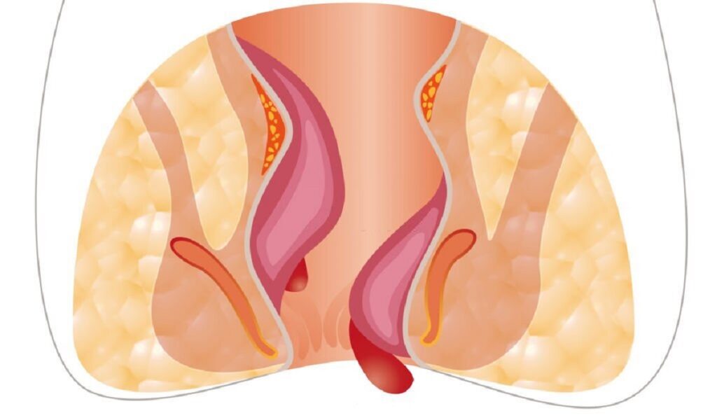 External hemorrhoids causes, symptoms and how to treat them.