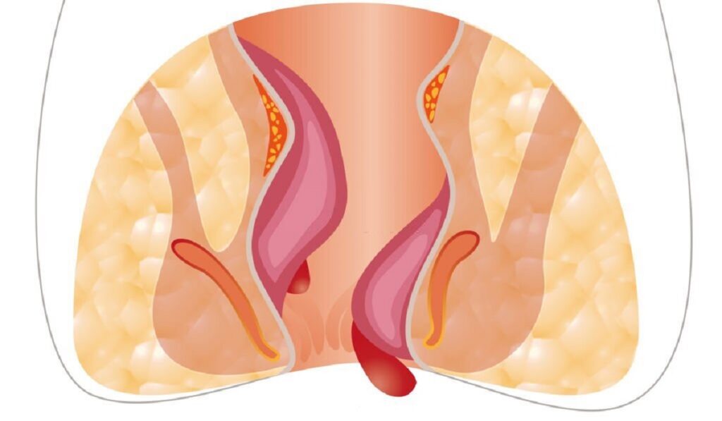 internal hemorrhoid swelling