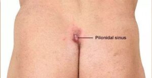 pictures of pilonidal sinus