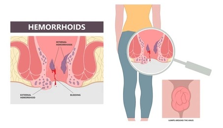 Hemorrhoids treatment in one day in Dubai