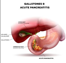 Gallbladder stones