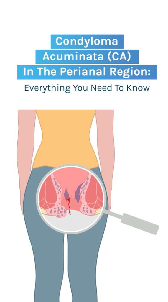 Condyloma Acuminata (CA) In The Perianal Region
