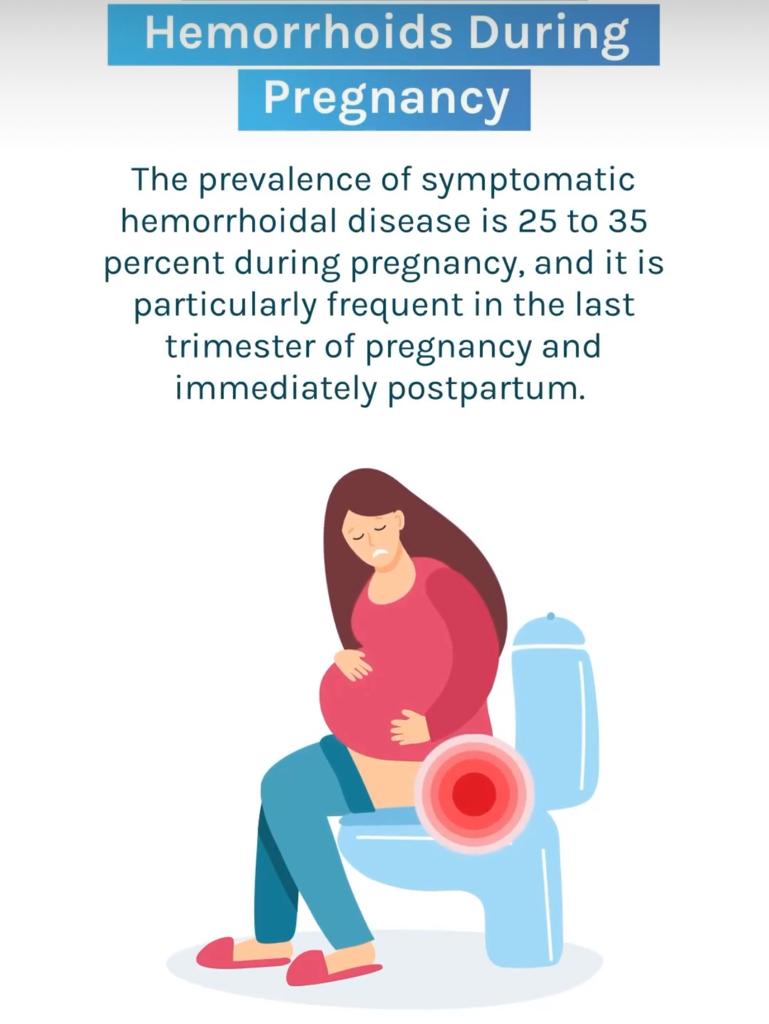 Как управлять геморроидами во время беременности