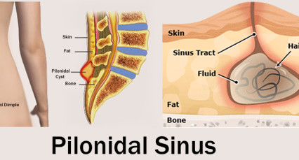 Pilonidal sinus treatment without surgery