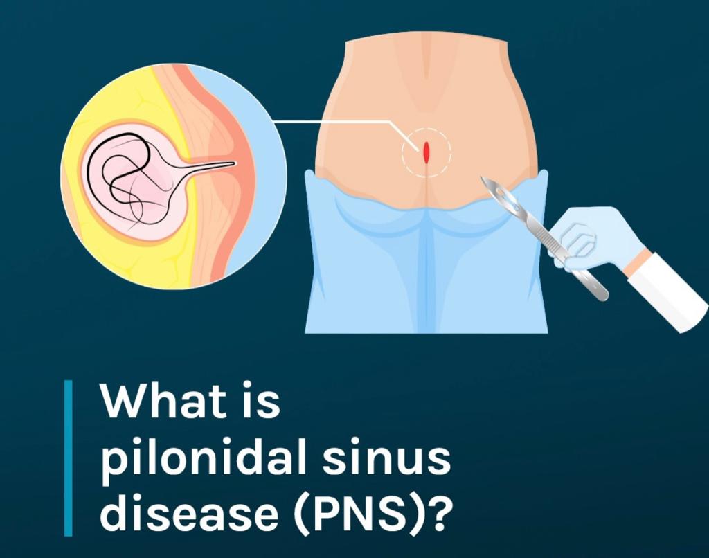 What is pilonidal sinus disease (PNS)