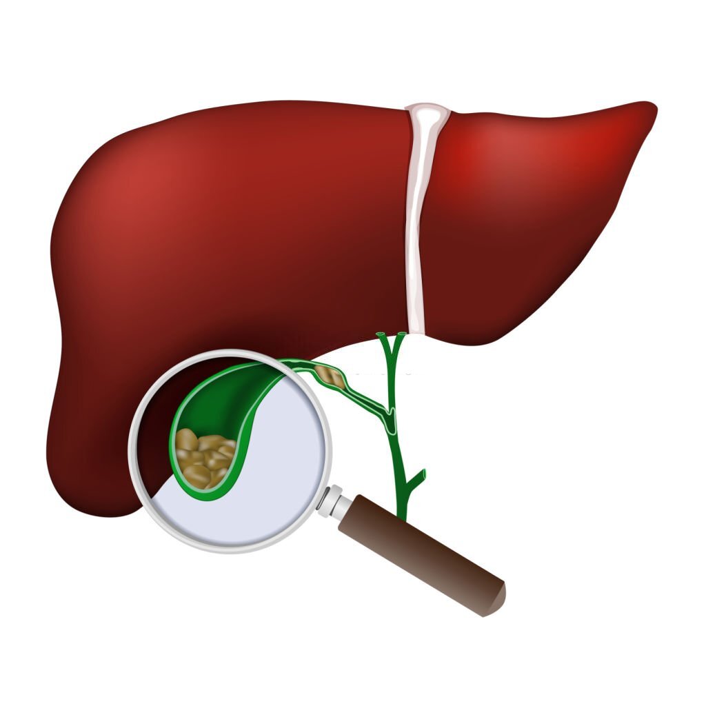 When should individuals seek medical intervention for gallstones