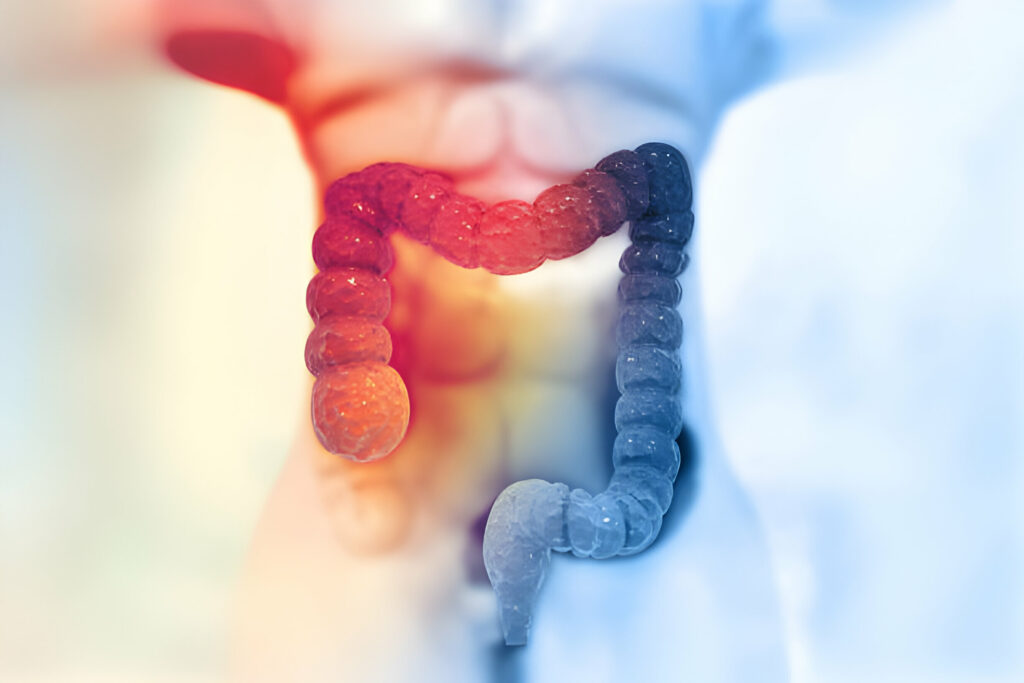 what causes colon cancer in females