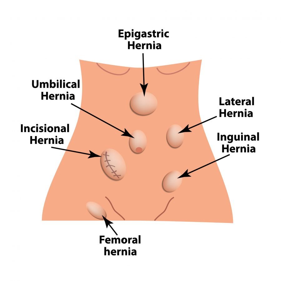 Abdominal Wall Herni