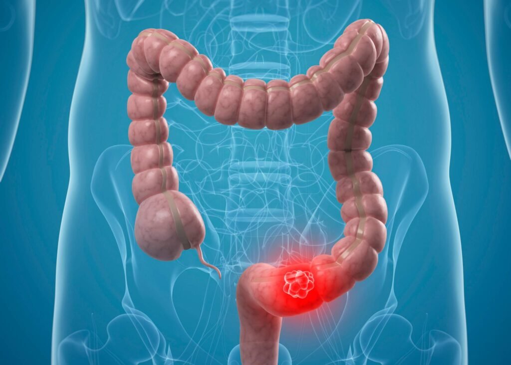 Colon-Cancer_-Sympto.jpg