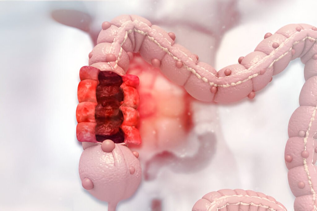 Expertise in Hemorrhoids Treatment