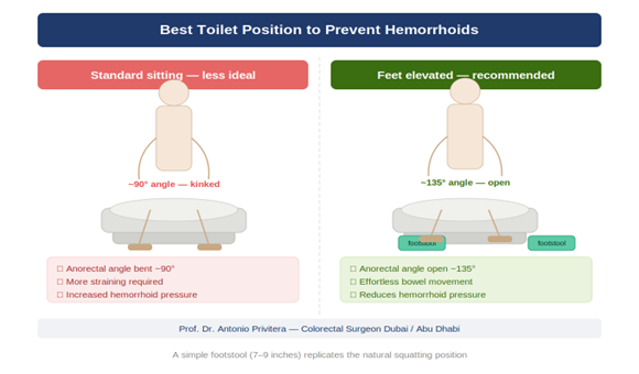 Best toilet position infographic comparing standard sitting versus feet elevated with footstool for hemorrhoids