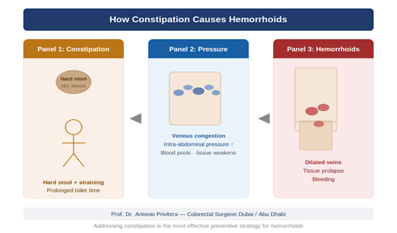 How low-fibre diet causes constipation which leads to hemorrhoids through straining and venous congestion