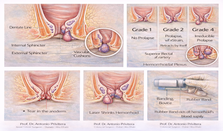 Hemorrhoid anatomy showing grades, laser treatment and rubber band ligation by Dubai colorectal surgeon