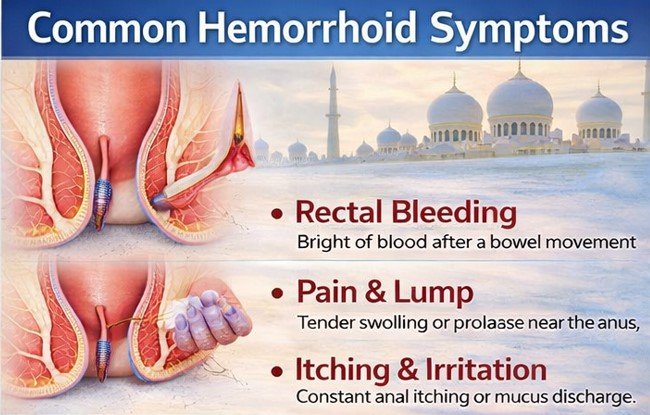 Common hemorrhoid symptoms including bleeding itching and prolapse