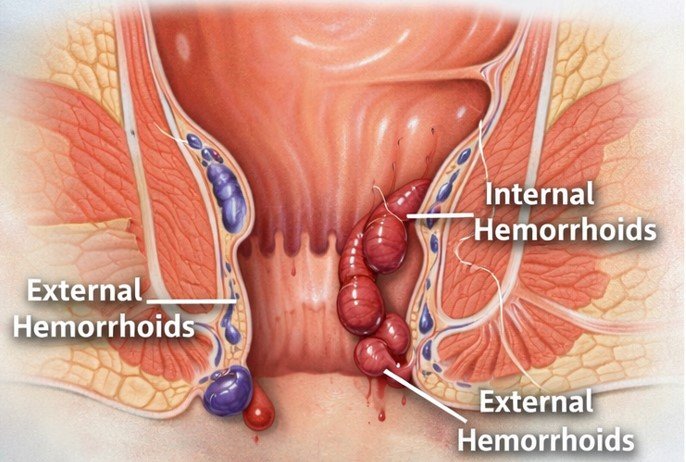 Diagram comparing internal vs external hemorrhoids